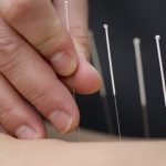 Abdominal Acupuncture